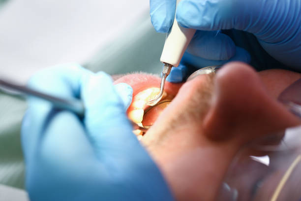 Best Chipped Tooth Repair Near Me  in Dothan, AL